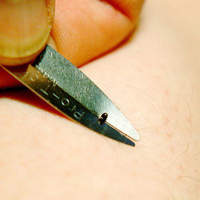 Protick removing engorged deer tick nymph